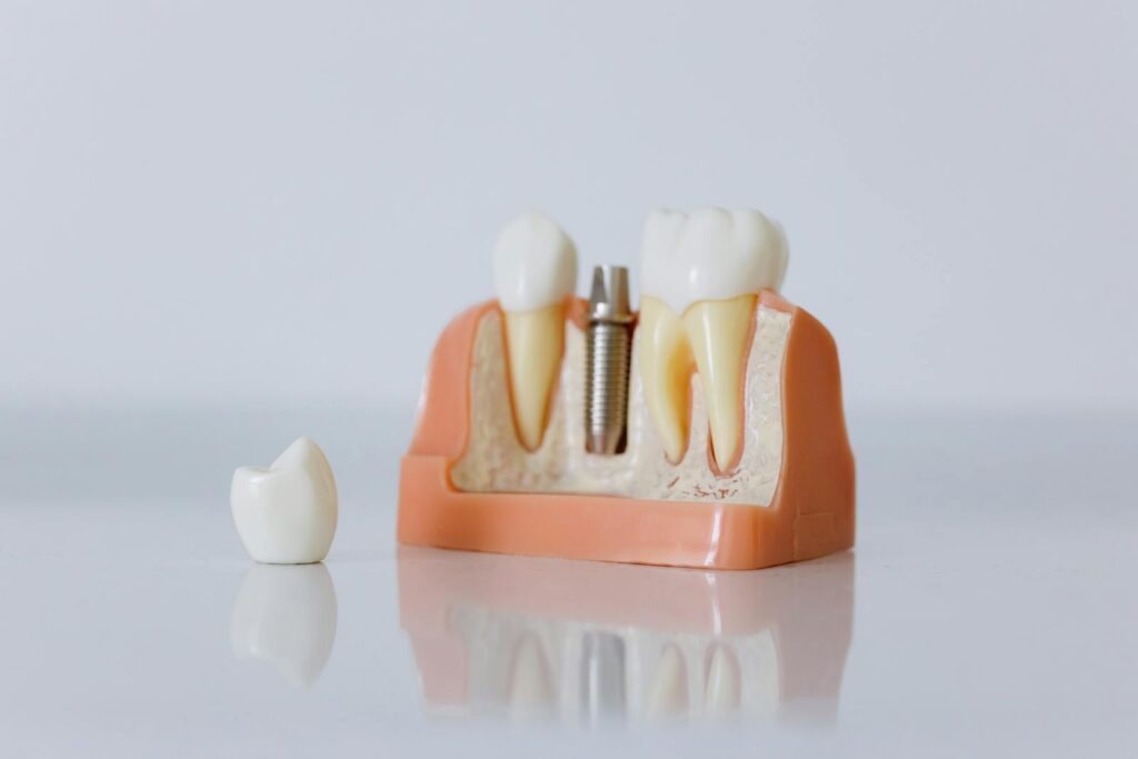 Close-up of a dental implant model featuring artificial teeth and jaw structure.