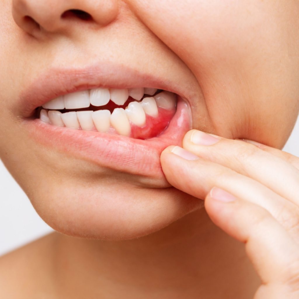 Close-up of a person showing inflamed gums while pointing to the affected area, illustrating symptoms of gum disease relevant to ARESTIN treatment for periodontal health.